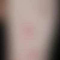sarcoidosis: subcutaneously knotty form of sarcoidosis. recurrent course for several years. devel...