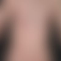 Scabies: Massively itchy clinical picture with disseminated, pinhead- to lenticular-sized, centra...