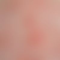 Scabies: Detailaufnahme.&nbsp;Rote,&nbsp;stellenweise erodierte Papeln. Lineare Anordnung hier mi...