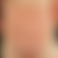 scabies. severely itching, disseminated, pinhead to lentil-sized, centrally eroded papules on the...