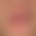 Syphiis: papulöses Syphilid.&nbsp; Akne-artiges Krankheitsbild mit disseminierten nicht juckenden...