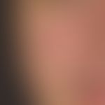 Syphiis: papulöses Syphilid.&nbsp; Akne-artiges Krankheitsbild mit disseminierten nicht juckenden...