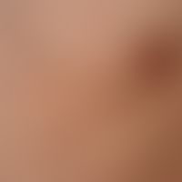 Syphilis (early syphilis): macular, chronic exanthema. in places fading erythema is also found. d...