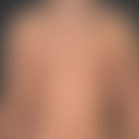 Syphilis (early syphilis): macular, chronic exanthema. Fading erythema is also found in places. A...