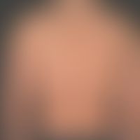 Syphilis: Early syphilis; purely macular non-itching dense exanthema.
