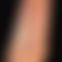 Syphilis Early syphilis: maculo-papular , plantarsyphilid.
