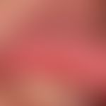Syphilis: Primäraffekt; derbes,&nbsp;nicht schmerzendes Ulkus (DD: Aphthe). Aufgeworfener Randwall.
