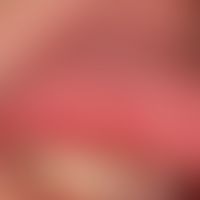 Syphilis: Primäraffekt; derbes,&nbsp;nicht schmerzendes Ulkus (DD: Aphthe). Aufgeworfener Randwall.
