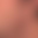 Spätsyphilis: asymmetrische, völlig symptomlose, aniläre, granulomatöse rotbraunen Plaque.
