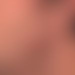 Late syphilis: asymmetrical, completely symptomless, anilary, granulomatous reddish-brown plaque.

