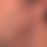 Late syphilis: asymmetrical, completely symptomless, anilary, granulomatous reddish-brown plaque.
