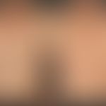 Early syphilis: maculo-papular syphilide, generalized swelling of lymph nodes. Positive syphilis ...
