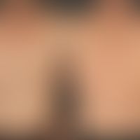 Early syphilis: maculo-papular syphilide, generalized swelling of lymph nodes. Positive syphilis ...