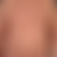 Syphilide, papular: multiple, disseminated, dense, small, reddish papules and nodules on a tanned...