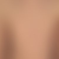 Early syphilis: papular syphilide. Totally asymptomatic exanthema. Generalized non-tolent lymph n...