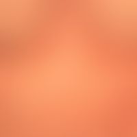 Syphilide, papular. multiple, acute, still increasing, generalized (trunk, extremities, palms of ...