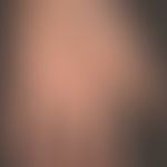 Syphilis: papulöses Syphilid der Handflächen. Locker verteilte rot-bräunliche, schuppende, sympto...