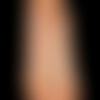 Syphilis: papulöses Syphilid der Fußsohlen. Locker verteilte rot-braune schuppende, symptomlose P...