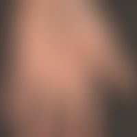 Syphilis Early syphilis: a long-standing, distinct, locally psoriasiform papular palmar syphilis.

