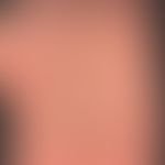 Syphilis Frühsyphilis: diskretes, nicht juckendes oder schmerzendes,&nbsp;makulo-papulöses Palmar...