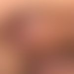 Syphilis Frühsyphilis. Primäraffekt. Seit 3 Wochen bestehender Primäraffekt. Ulkus, derb, wenig d...