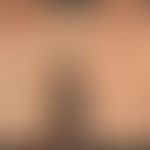 Syphilis Frühsyphilis: papulöses Syphilid. Kein Juckreiz. Generalisierte Lymphknotenschwellung. S...