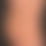 Syphilis Frühsyphilis: makulo-papulöses, stellenweise psoriasiformes &nbsp;Syphilid
