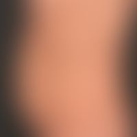 Syphilis Early syphilis: maculo-papular , sometimes psoriasiform syphilis
