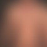 Syphilis Frühsyphilis: dichtes, makulo-papulöses Exanthem
