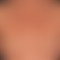 Syphilis early syphilis: maculo-papular syphilide, in places aligned with the tension lines of th...