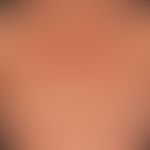 Syphilis acquisita. Makulo-papulöses Syphilid. Stellenweise&nbsp;nach den Spannungslinien der Hau...