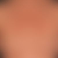 Syphilis acquisita. maculo-papular syphilide. in places aligned with the tension lines of the ski...