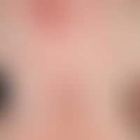 Pemphigus erythematosus: since about 1 year recurrent, symmetrical, red, rough plaques with coars...