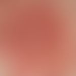 Pemphigus erythematosus. Detailaufnahme: gerötete, unscharf begrenzte,&nbsp;blätterteigartig schu...