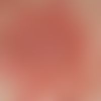 Pemphigus erythematosus. Detailaufnahme: gerötete, unscharf begrenzte,&nbsp;blätterteigartig schu...