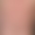 Pemphigus erythematosus: seit mehreren Jahren&nbsp; rezidivierende, symmetrische, wenig symptomat...