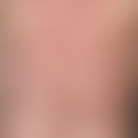 Pemphigus erythematosus: for several years recurrent, symmetrical, little symptomatic, red, plaqu...