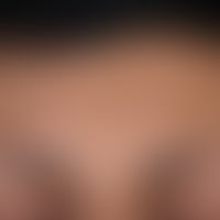 Ulerythema ophryogenes: beidseitiges Ulerythem mit diskreter Rötung der Haut und Rarefizierung de...