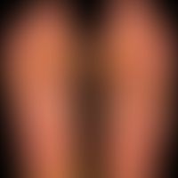Verrucae plantares: papules and plaques on the sole of the foot of a 52-year-old man, which have ...