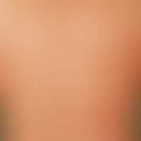 Xanthoma disseminatum: chronic form of xanthogranulomatosis with symmetrically distributed, here ...