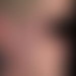 Xanthogranulom nekrobiotisches mit Paraproteinämie. Bei der 62-jährigen Patientin zeigen sich meh...