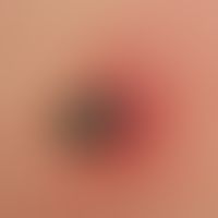 Zeckenstich:&nbsp; bereits mit Blut gefüllte Zecke beim Saugakt. Detailaufnahme.
