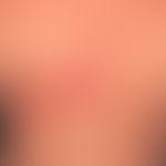 Zoster: in segmentaler Verteilung, gruppierte Bläschen und Pusteln auf geröteter Haut bei einem 3...
