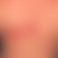 Zoster: in segmentaler Verteilung, gruppierte Bläschen und Pusteln auf geröteter Haut bei einem 3...