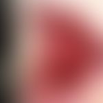 Zoster mucosae: ungewöhnlich lokalisierte Zostererkrankung der Wangenschleimhaut.
