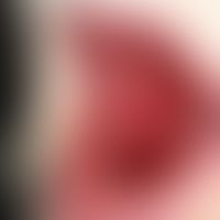 Zoster mucosae: ungewöhnlich lokalisierte Zostererkrankung der Wangenschleimhaut.
