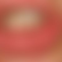 Mucoid cyst of the lower lip after a bite wound (detailed picture)
