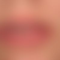 Mucoid cyst of the lower lip after bite wound.
