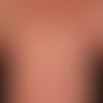 Morbilliformes Exanthem: wenige Tage altes, dichtes makulöses Virusexanthem mit Fieber, Abgeschla...