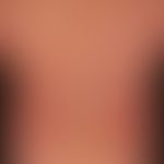 Morbilliformes Exanthem: wenige Tage altes, dichtes makulöses Virusexanthem mit Fieber, Abgeschla...
